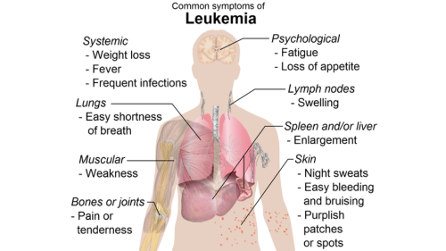 Leukemia Explained: Causes, Symptoms, Diagnosis, and Treatment