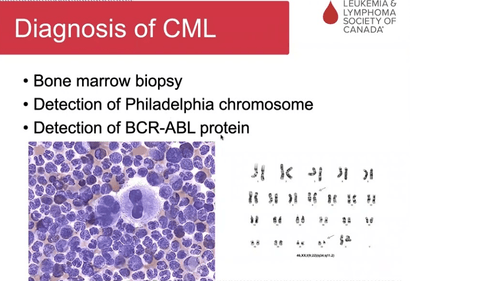 Chronic Myelogenous Leukemia (CML): Symptoms, Diagnosis, Treatment, and Success Rate