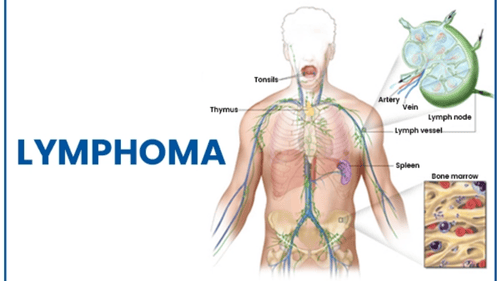 Lymphoma: What Is It, Causes, Treatment, and Recovery