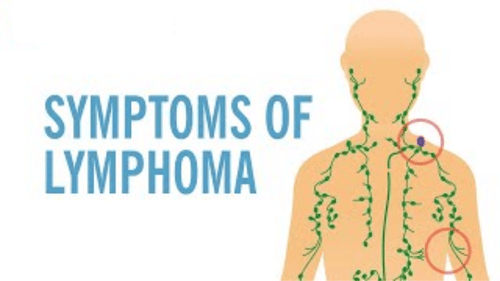 Hodgkin's Lymphoma: Symptoms, Treatment, and Recovery