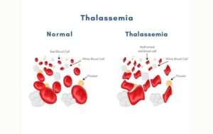 Gene Therapy for Thalassemia Major: A Breakthrough in Treatment