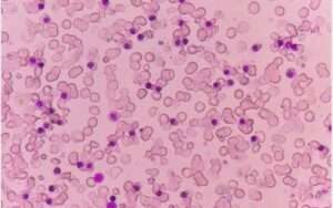 Thalassemia Minor Treatment: Everything You Need to Know