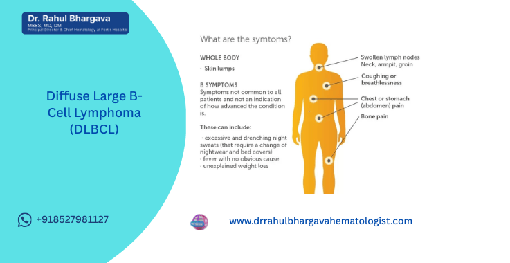 Understanding DLBCL: A Complete Guide