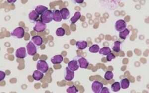 What You Need to Know About Acute Lymphoblastic Leukemia