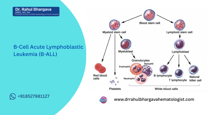 B-Cell Acute Lymphoblastic Leukemia (B-ALL): A Detailed Guide
