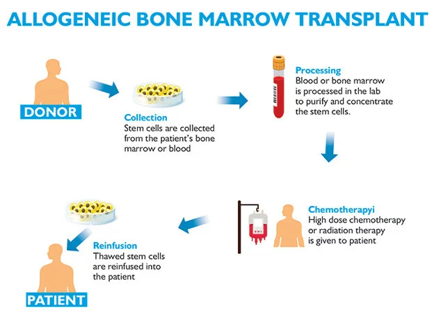 Allogenic Bone Marrow Transplant Cost in India