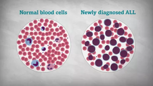 Acute Lymphoblastic Leukaemia (ALL) Treatment in India