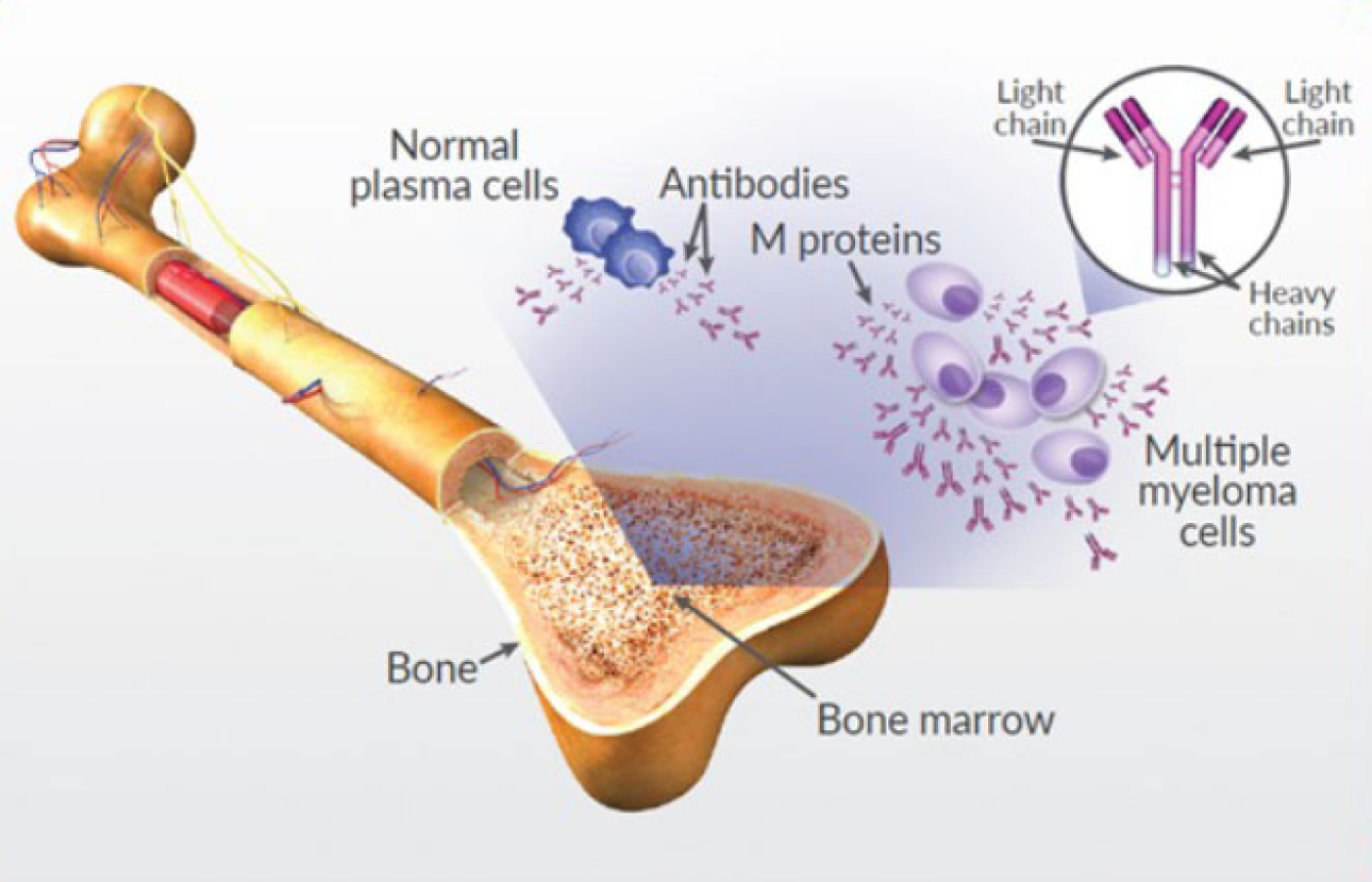 Multiple Myeloma Treatment Cost in India