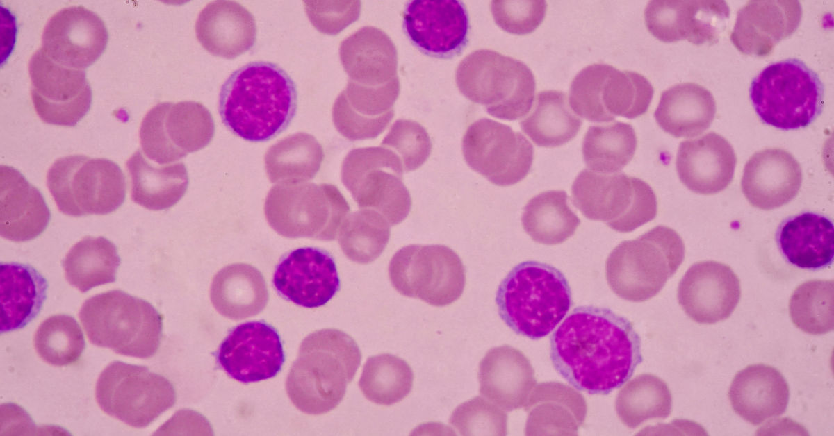 Acute Myelogenous Leukemia (AML) Treatment in India