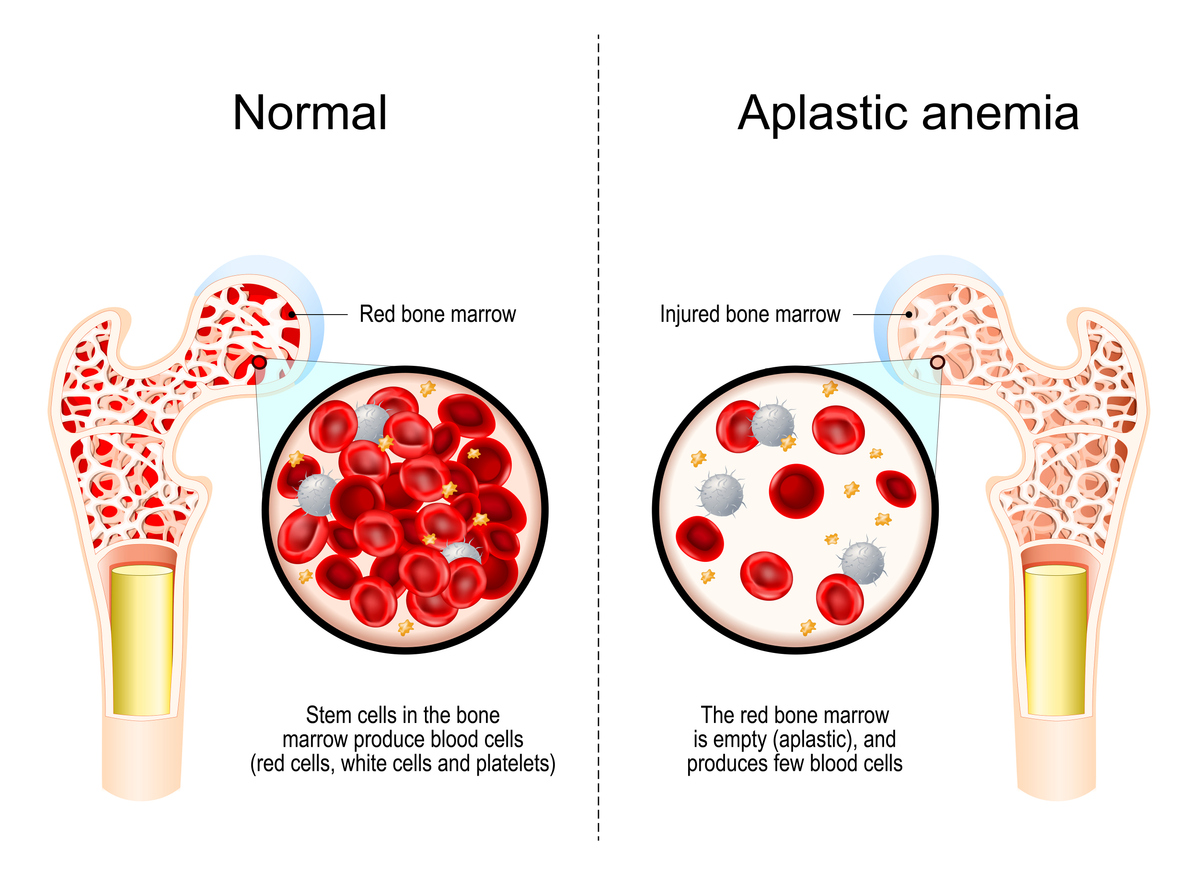 Aplastic Anemia Treatment Cost in India