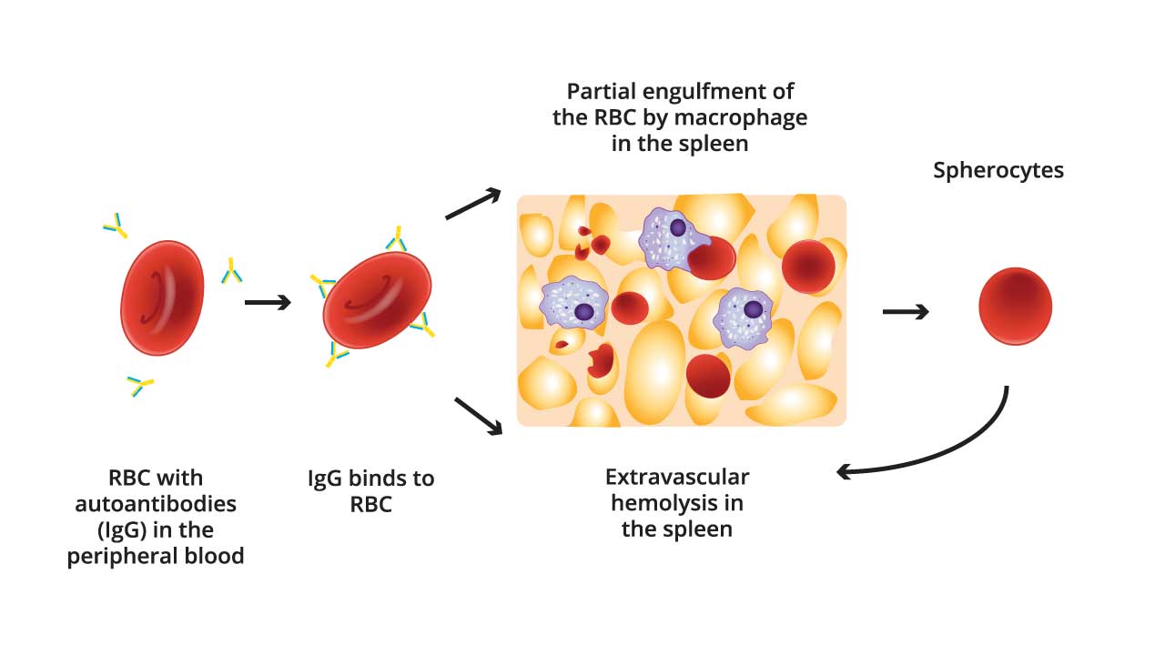 Autoimmune Hemolytic Anemia (AIHA) Treatment in India