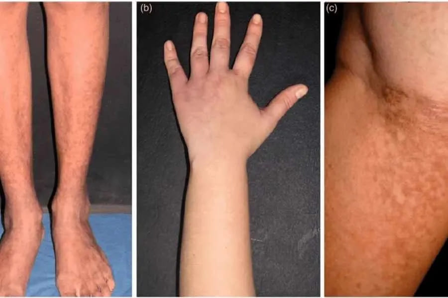 Antiphospholipid Syndrome (APS) Treatment in India