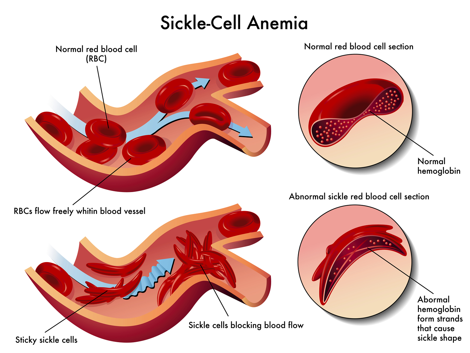 Sickle Cell Anemia (SCA) Treatment in India