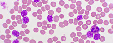 Acute Lymphocytic Leukemia Treatment in India
