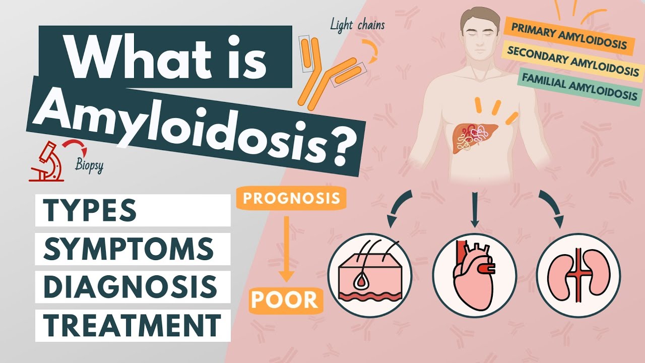 Amyloidosis Treatment in india