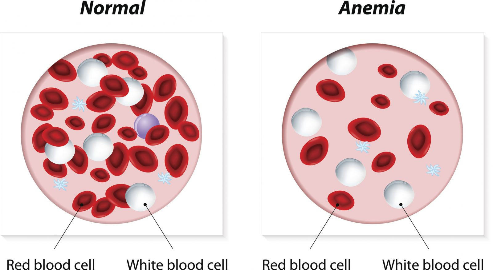 Anemia Treatment in India