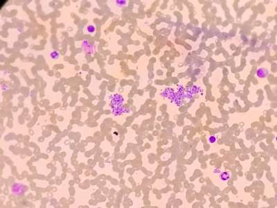 fanconi anemia
