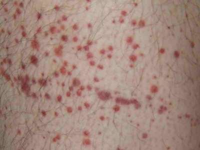 Autoimmune Thrombocytopenia