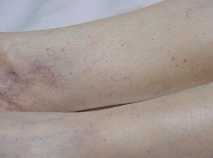 Thrombotic thrombocytopenic purpura (TTP)