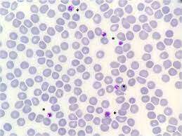 Bernard Soulier Disease