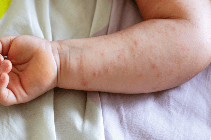 Wiskott-Aldrich Syndrome