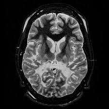 Adrenoleukodystrophy