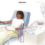 Stem Cell Transplant